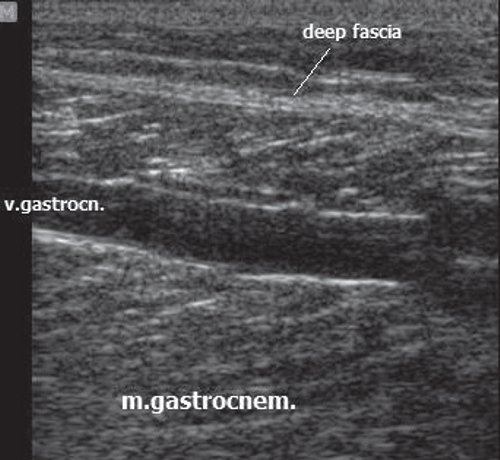 Эхограмма в области медиальной головки икроножной мышцы на уровне верхней трети голени