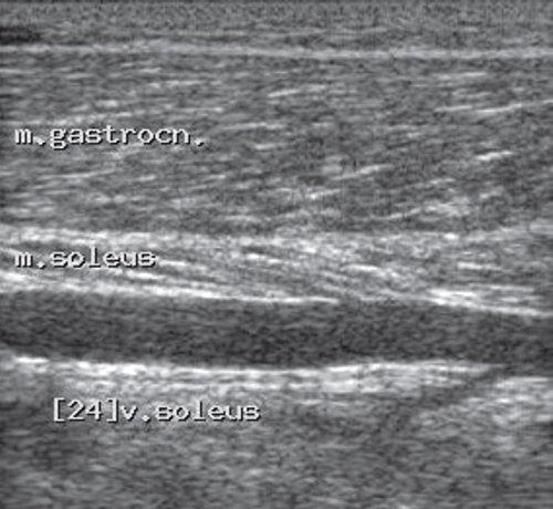 Эхограмма в области мышечного массива на уровне нижней трети голени по задней поверхности