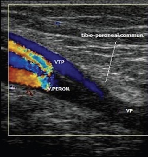 Эходопплерограмма тибиоперонеального соединения (граница верхней трети голени с подколенной ямкой)