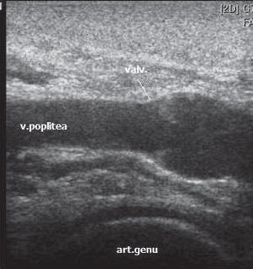 Эхограмма подколенной вены (v. poplitea) на уровне подколенной ямки