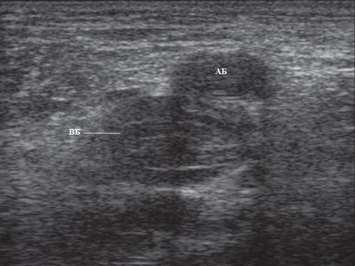 Эхограмма бедренного сосудистого пучка на уровне средней трети бедра (АБ - бедренная артерия, BБ - бедренная вена)