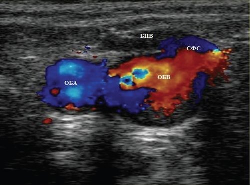 Эходопплерограмма в области сафено-феморального соустья (ОБА - общая бедренная артерия, ОБВ - общая бедренная вена)