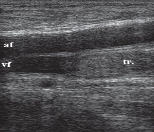 Эхограмма в области бедренного сосудистого пучка на уровне верхней трети бедра