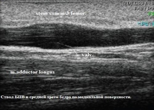 Эхограмма ствола большой подкожной вены в средней трети бедра