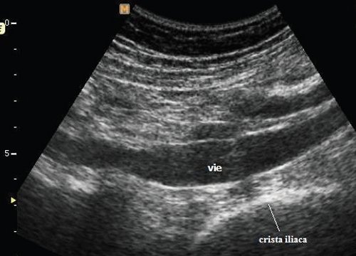 Эхограмма наружной подвздошной вены на уровне гребня подвздошной кости