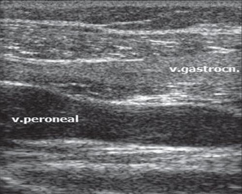 Эхограмма на границе средней и нижней трети голени по задней поверхности (v.peroneal - перонеальная или малоберцовая вена)