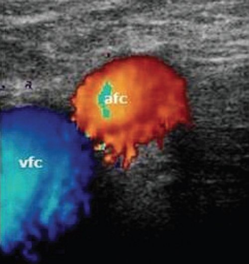 Эходопплерограмма общего бедренного сосудистого пучка на уровне паховой складки