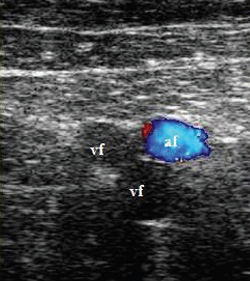 Эходопплерограмма на уровне средней трети бедра по медиальной поверхности