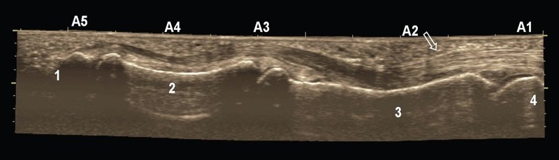Панорамная сонограмма продольного среза глубокого и поверхностного сухожилий сгибателя пальца