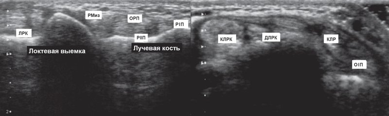 Поперечная эхограмма разгибателей кисти