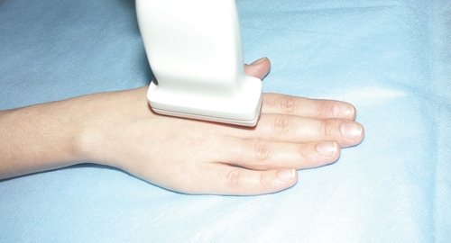 Расположение ультразвукового датчика при исследовании тыльной поверхности кисти (продольное сканирование)