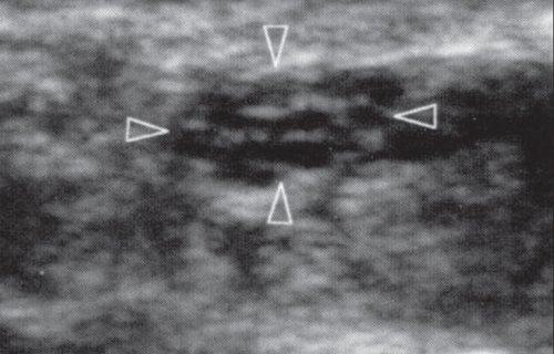 Поперечная сонограмма срединного нерва на уровне карпального канала