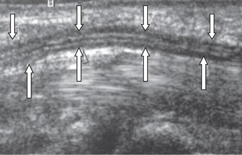 Продольная сонограмма срединного нерва (светлые стрелки) на уровне карпального канала
