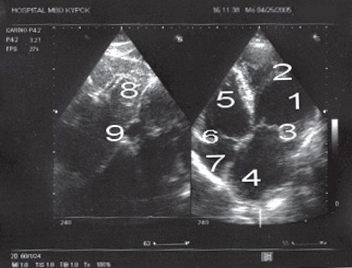 Эхокардиограмма больного П (четырехкамерная проекция)