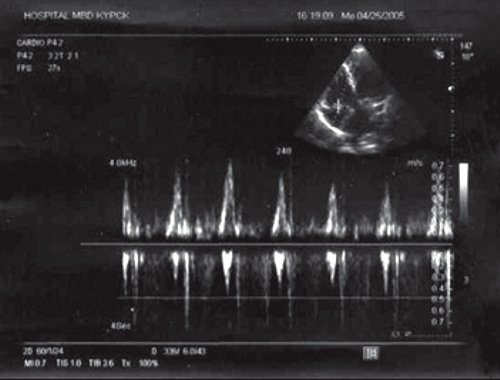Трансмитральный поток у больного П ((импульсноволновая допплерография)