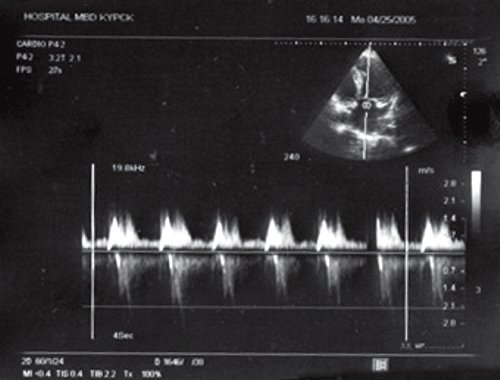 Транстрикуспидальный поток у больного П (постоянноволновая допплерография)