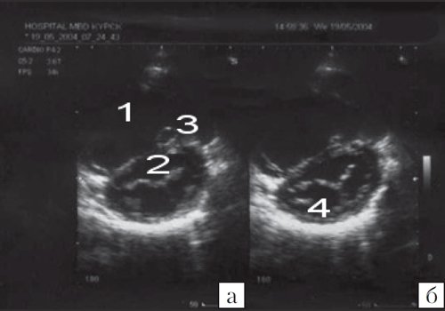 Эхокардиограмма больного С (парастернальная позиция по короткой оси на уровне митрального клапана)