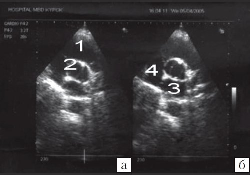 Эхокардиограмма больного