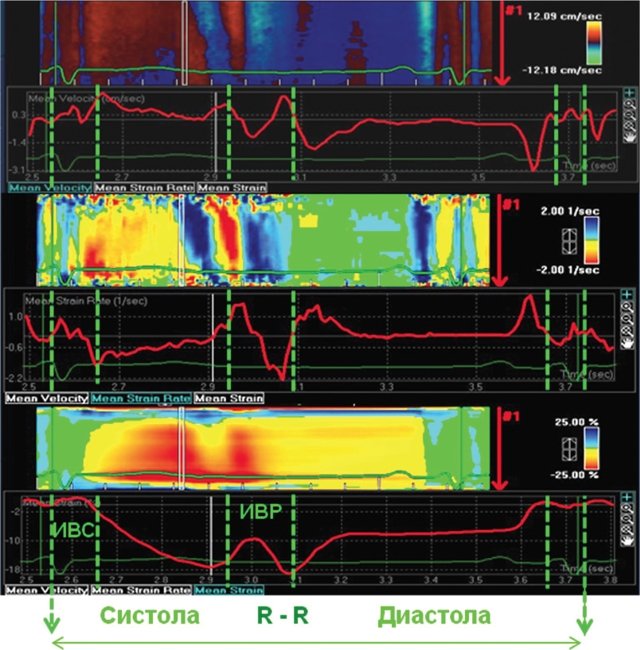 Пример определения длительности изоволюмических фаз при постобработке данных тканевого допплеровского исследования у пациента с выраженной ГЛЖ