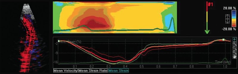 Пример анализа цветового М-следа и графиков продольной деформации (ε) боковой стенки ЛЖ в норме
