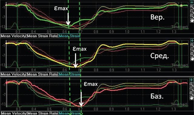 Задержка максимального стрейна на графиках от верхушки до базального сегмента ЛЖ