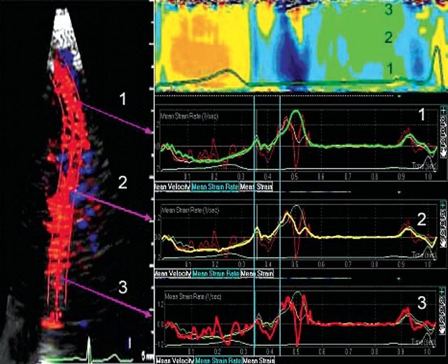 ТДИ. Анализ М-следа и графиков скорости деформации (SR) миокарда в норме в трех сегментах боковой стенки