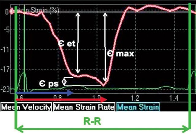 График средней деформации миокарда (mean strain) миокарда МЖП в норме