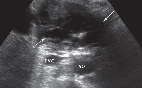 Множественные кистозные образования двенадцатиперстной кишки (указано стрелками), AO - аорта, IVC - нижняя полая вена