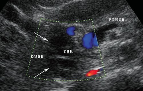 Эхограмма кистозного образования (TUM) в стенке двенадцатиперстной кишки (DUOD) на фоне неизмененной паренхимы поджелудочной железы