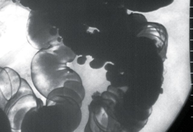 Рентгенологическая картина дивертикулеза толстой кишки