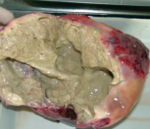 Правая доля печени (макропрепарат) - альвеококкоз, ткань паразита цвета слоновой кости