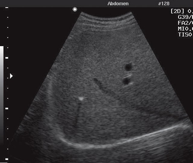 Кальцинат в паренхиме печени с типичным феноменом акустической тени