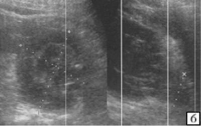 Эхограмма левой почки через 7 дней после травмы