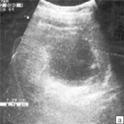 Эхограмма левой почки больной