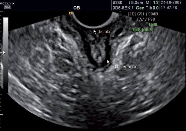 Эхограмма - разрыв промежности 3-й степени, ректо-вагинальный свищ