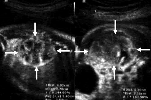 Эхограмма - почки плода, видна разница в эхографической структуре, границы почек обозначены стрелками