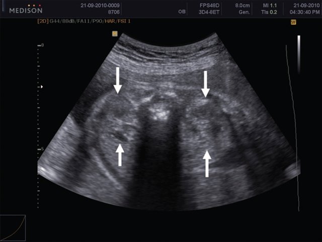 Эхограмма - почки плода (поперечное сканирование), передне-задний размер почек обозначен стрелками