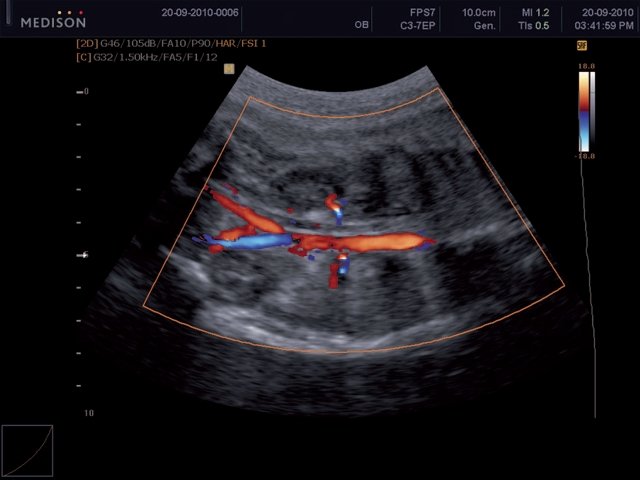 Эхограмма (режим ЦДК) - почки плода (продольное сканирование), видны почечные артерии
