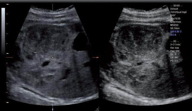 Эхограмма почек плода, методика VCI (объемное контрастное изображение), границы опухоли видны более четко, чем в режиме 2D