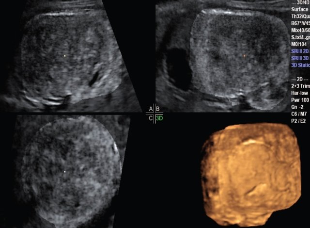 Эхограмма (режим 3D реконструкции) - изображение в трех взаимно перпендикулярных плоскостях позволяет оценить форму опухоли