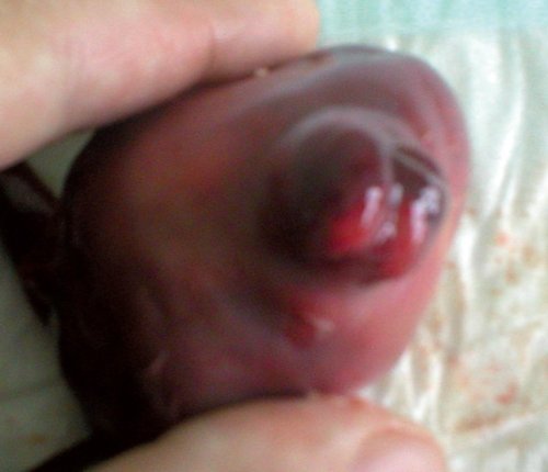 Фотография - абортус, энцефалоцеле, синдром Меккеля-Грубера (б)