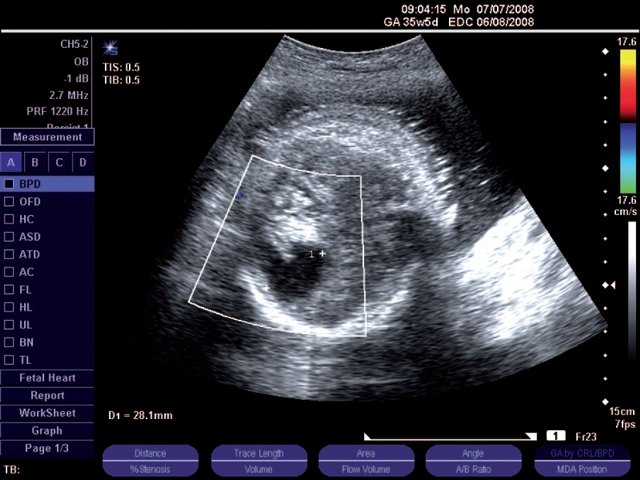 Эхограмма (режим ЦДК) - шизэнцефалия, II тип, беременность 35 недель