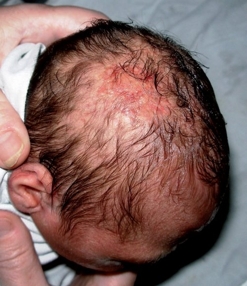 Фотография новорожденной с шизэнцефалией II типа - врожденная аплазия кожи в правой теменной области