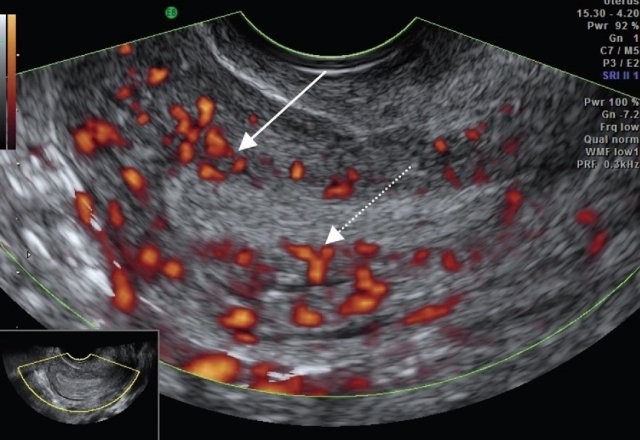 Эхограмма - васкуляризация эндометрия и субэндометриального слоя (базальные сосуды указаны сплошной стрелкой, спиральные сосуды - пунктирной стрелкой)