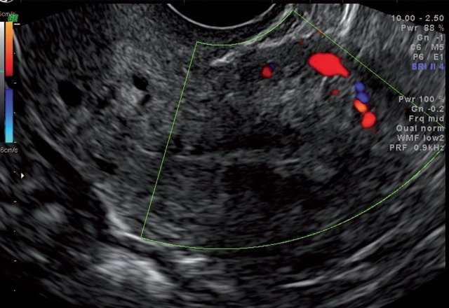 Эхограмма - физиологическая гиповаскуляризация миометрия в постменопаузе, определяются только аркуатные сосуды