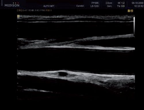 Эхограмма (В-режим) - стенка ОСА здорового человека