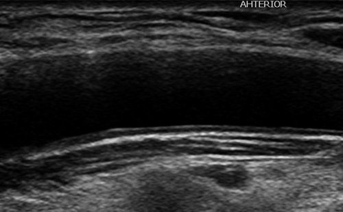 Эхограмма (В-режим) - дистальный сегмент правой ОСА, передний доступ