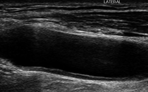 Эхограмма (В-режим) - дистальный сегмент правой ОСА, латеральный доступ