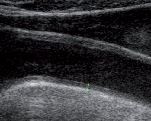 Эхограмма (В-режим) - утолщенная стенка ОСА