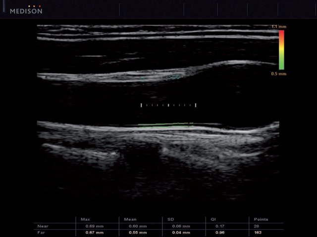 Эхограмма - измерение толщины комплекса интима-медиа (ТИМ) ОСА, автоматический режим